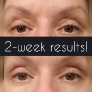2-Weeks-Eyelids