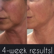 4-Weeks-Lower-Face-and-Jawline