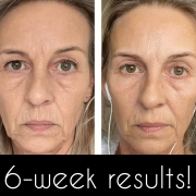 6-Weeks-Full-Face-2